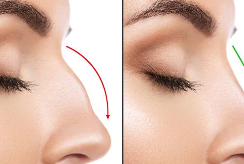 5fd9e6647e51bec82775e2fd_Is-Rhinoplasty-Surgery-safe-1400x700