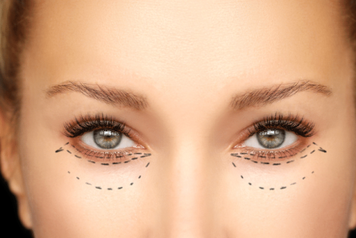 Blepharoplasty-Surgery-Risks-Eyelid-Surgery-Risks-Complications