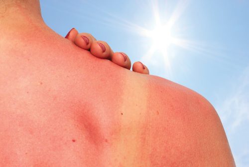 MelanomaChamp-750x375@2x