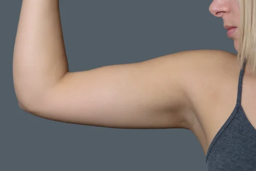 brachioplasty-achieve-toned-beautiful-arms-featured