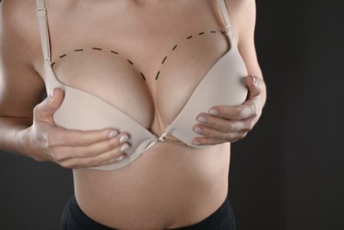 swelling-day-by-day-breast-augmentation-recovery